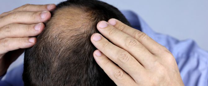 Man concerned about hair loss